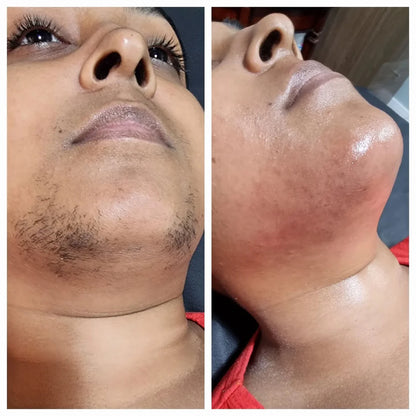 Huile d'Epilation au Cyperus Rotundus
