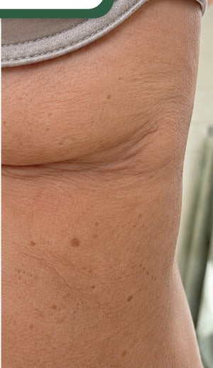 Skin fold after