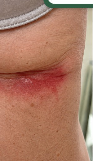 Skin fold before