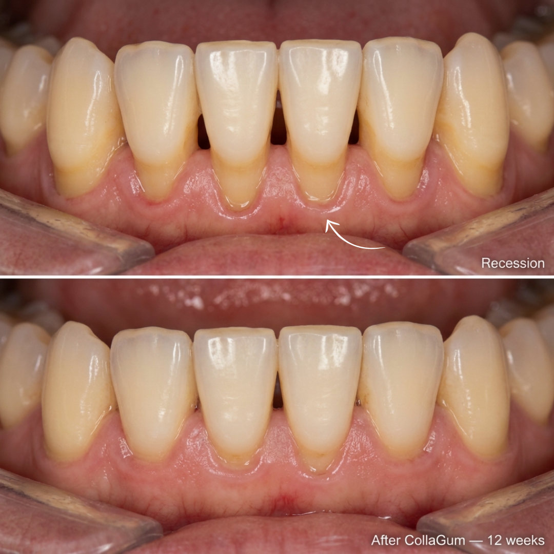 Lindalia CollaGum Gum Rebuild Collagen Powder